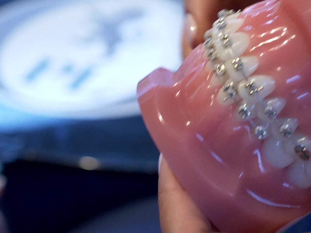 Close-up of a demonstration model fitted with fixed metal braces
